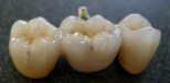 All On Four Dental Implants Long Island